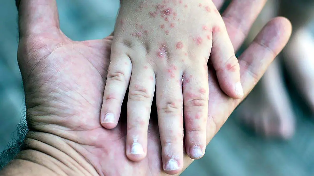 Suman 40 casos sospechosos de sarampión en Baja California